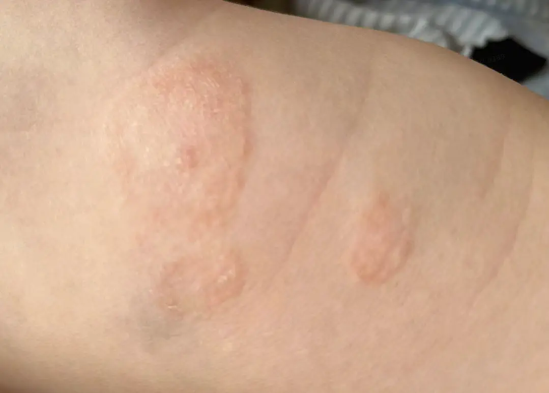 baby_dry_eczema_1.webp