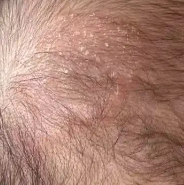 baby_dry_eczema_2.webp